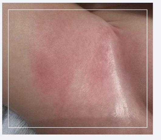 Diaper-area redness, before